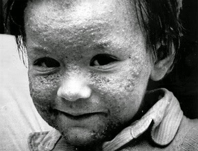 Infant amb la cara coberta de lesions de cloracne després de l'accident de Seveso